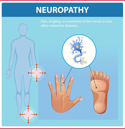 What is Diabetic Neuropathy?